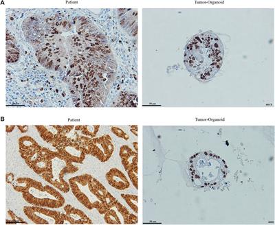 3-Dimensional Model to Study Apoptosis Induction of Activated Natural Killer Cells Conditioned Medium Using Patient-Derived Colorectal Cancer Organoids